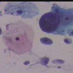 Πολυπύρηνο κύτταρο ενδοτραχηλου